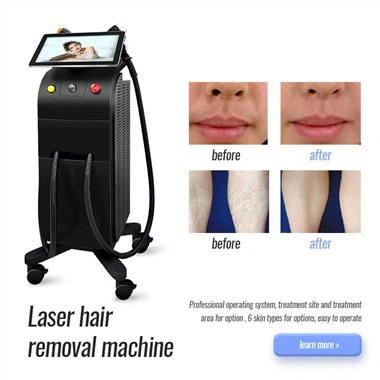 Titan lasersko uklanjanje dlačica