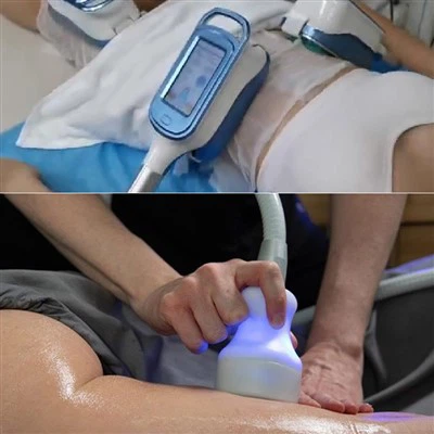 Trošak stroja za coolsculpting